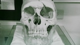 La calavera de Phineas Gage