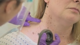 Skin Tag, You're It!