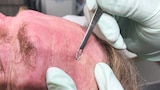 Surprising Blackhead Extraction