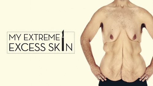Watch My Extreme Excess Skin | Season 3 Episode 7 | discovery+