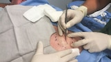 Lower Back Lipoma