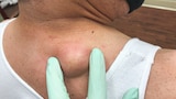 Hidden Pocket Cyst